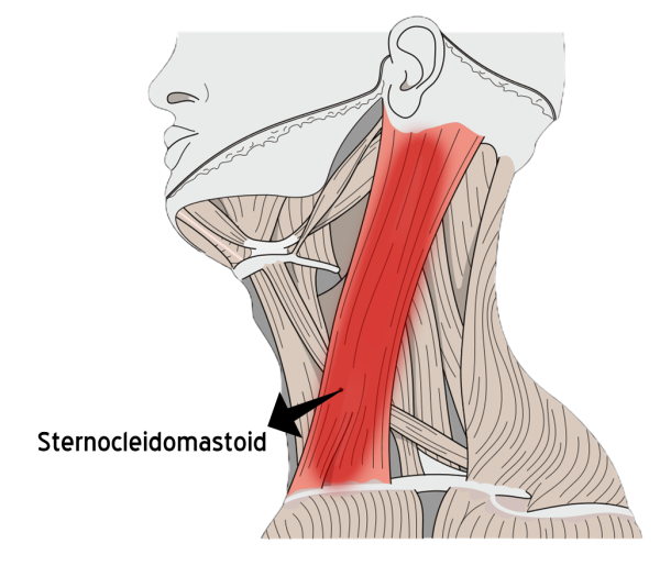 Sternocleidomastoid